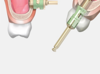 Sinus Lift